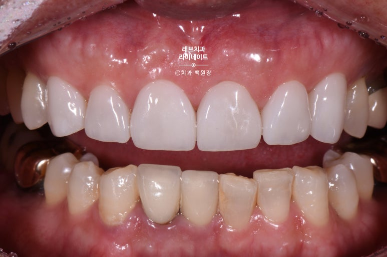 신사역 무삭제 라미네이트 : 레브네이트 내츄럴 최소삭제 비니어. 50대 앞니 벌어짐 비용/후기/얼굴사진. 관련 이미지 10