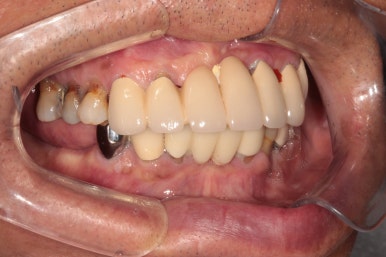 잇몸 염증 고름이 심했던 부위 - 만성치주염 진단하고 임플란트로 깔끔하게 치료! 신사역 치과 관련 이미지 5