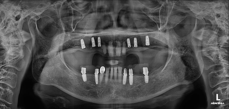 어금니 여러개가 없어요. 전체 임플란트와 앞니 크라운을 통한 완벽한 재건!! 치료과정/치료기간/비용/후기. 관련 이미지 21