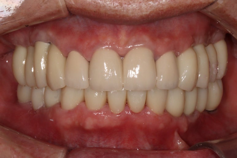 어금니 여러개가 없어요. 전체 임플란트와 앞니 크라운을 통한 완벽한 재건!! 치료과정/치료기간/비용/후기. 관련 이미지 34