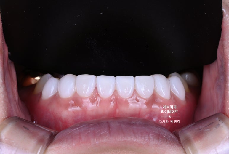 아래앞니 라미네이트도 무삭제로 가능한가요? 레브네이트 베이직 가격/비용/후기/추천. 관련 이미지 10