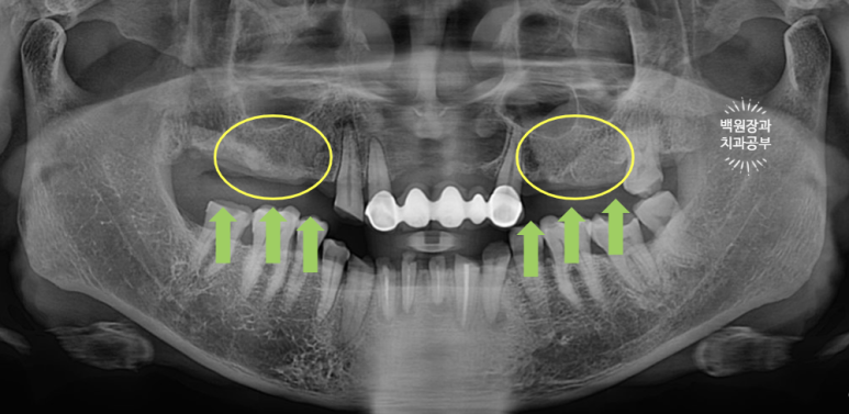 뿌리만 남은 앞니, 어금니가 없어 교합이 무너진 증례. 흡연자의 전체 오스템BA임플란트 재건증례. 치료과정/치료기간/비용/후기. 관련 이미지 7