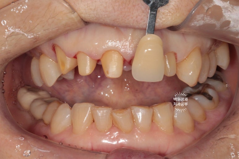 삐뚤빼뚤 앞니 세로 금  - 신경치료 없이 지르코니아 크라운으로. 상악동뼈이식술 임플란트. 관련 이미지 8