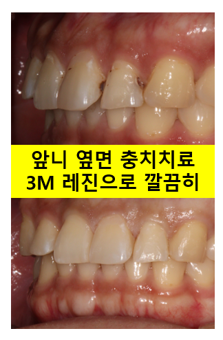 교정 유지장치 근처 앞니 옆면 충치 및 착색 간단히 3M 레진으로 치료. 치료과정/비용/후기. 과잉진료 없는 치과. 관련 이미지 2