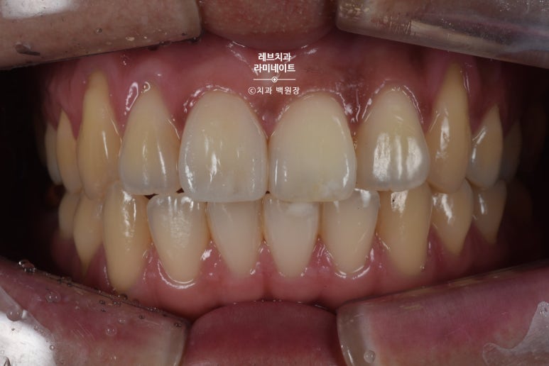 레브네이트 마스터 ; 예비신랑 앞니 무삭제라미네이트. 신사역 치과. 치료후기/비용/가격. 관련 이미지 12