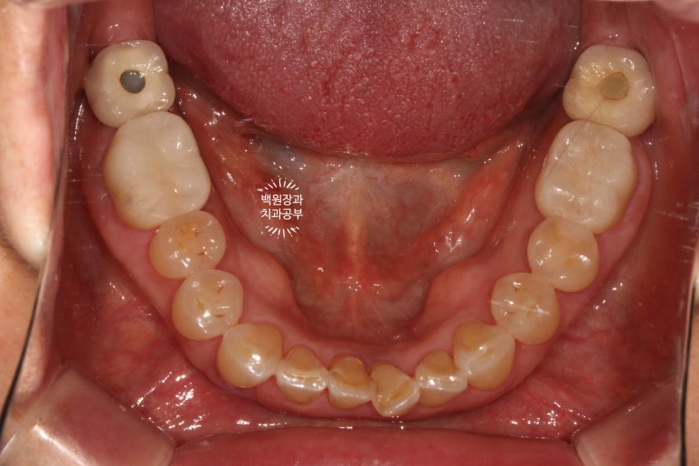 어금니 보철물이 떨어졌어요. 골드인레이 탈락 후 지르코니아 크라운으로 치료. 충치치료과정/치료기간/비용/후기. 관련 이미지 14