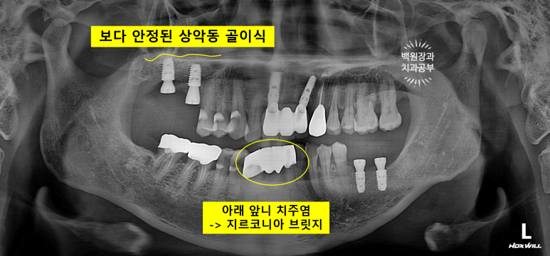 치주염으로 흔들리는 앞니부터 어금니 뼈이식 임플란트까지 - 5개월간 정성스러운 치료 과정. 관련 이미지 19