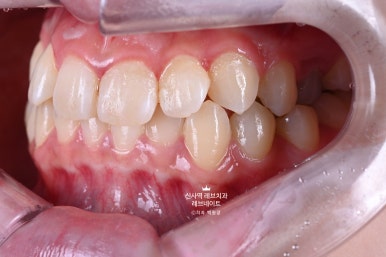 신사역 치과. 아나운서 면접 전 앞니 벌어진 공간을 라미네이트로만 해결할 수 있었던 사연.. 관련 이미지 29