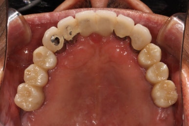 잇몸 염증 고름이 심했던 부위 - 만성치주염 진단하고 임플란트로 깔끔하게 치료! 신사역 치과 관련 이미지 33
