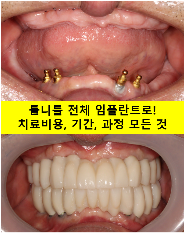 불편한 틀니를 아직도 쓰시나요? 전체 임플란트 치료비용/치료기간/치료과정. 관련 이미지 1