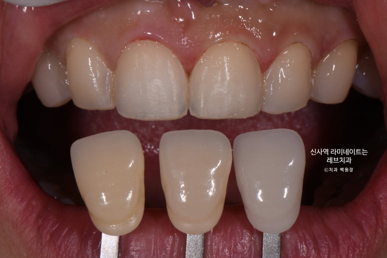 신사역 라미네이트, 잘하는 치과의 치료과정과 재료.설명.비용.후기. 관련 이미지 9
