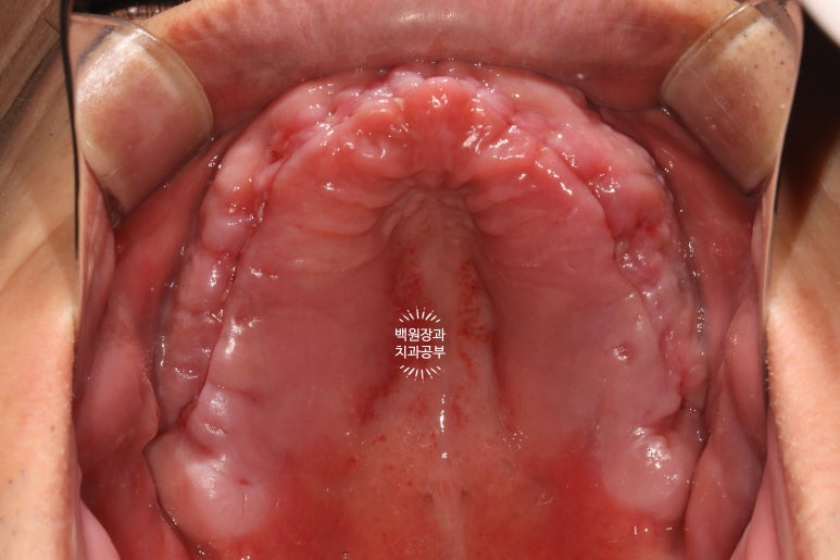 만성치주염으로 인해 아주 좁아진 잇몸뼈에 광범위한 뼈이식 + 전체임플란트. 신사 레브치과. 관련 이미지 30