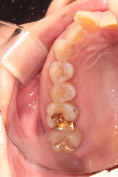 삐뚤어진 앞니를 8개월만에 가지런하게 만드는 50대 성인부분교정. 신사역 교정치과. 치료과정/기간/비용. 관련 이미지 4
