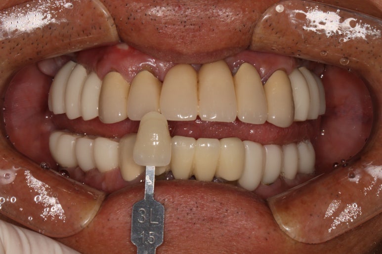 잇몸 염증 고름이 심했던 부위 - 만성치주염 진단하고 임플란트로 깔끔하게 치료! 신사역 치과 관련 이미지 24