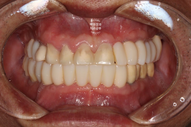 임플란트장인의 마음으로 8개월간 전체임플란트 완성. 치주과 전문의. 관련 이미지 22