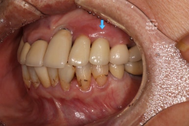 스트라우만 임플란트로 이뽑고 바로심는치과 - 믿고 사용하는 세계 1위 스위스 임플란트 회사. 관련 이미지 30