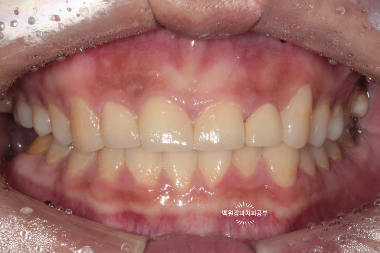 앞니에 잇몸염증과 충치가 심해요. 앞니 지르코니아 크라운 성공 후기. 치료과정/치료기간/비용/전후비교. 관련 이미지 20