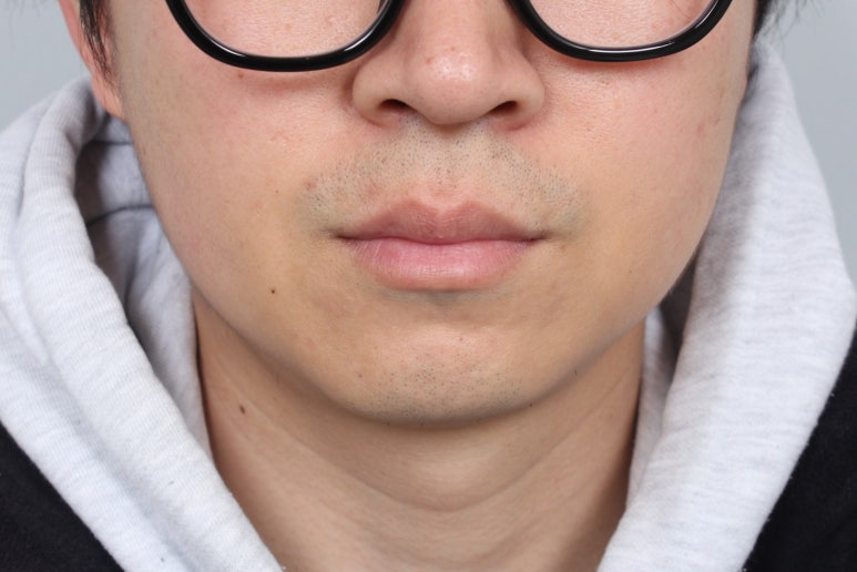 서울 신사역 [레브치과] 이갈이 보톡스 - 치과에서 코어톡스로 - 3개월 후기/주기/용량/가격. (의사작성) 관련 이미지 7