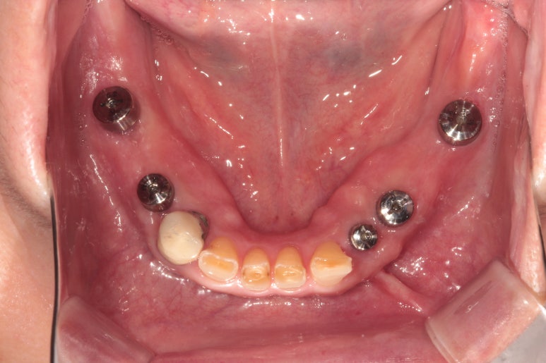 어금니 여러개가 없어요. 전체 임플란트와 앞니 크라운을 통한 완벽한 재건!! 치료과정/치료기간/비용/후기. 관련 이미지 12