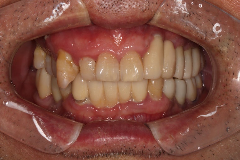 치주염 앞니 잇몸 염증으로 흔들릴 때 - 앞니 브릿지와 임플란트 장단점, 비용. 치료과정과 결과를 눈으로 보여주는 치과. 관련 이미지 4