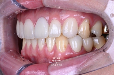 레브네이트 엑스퍼트 ; 유튜버가 선택한 앞니 라미네이트. 앞니 레진 벌어짐을 자연스러우면서 화사하게 바꿔봅시다. 신사역 치과. 치료후기/비용/가격. 관련 이미지 13