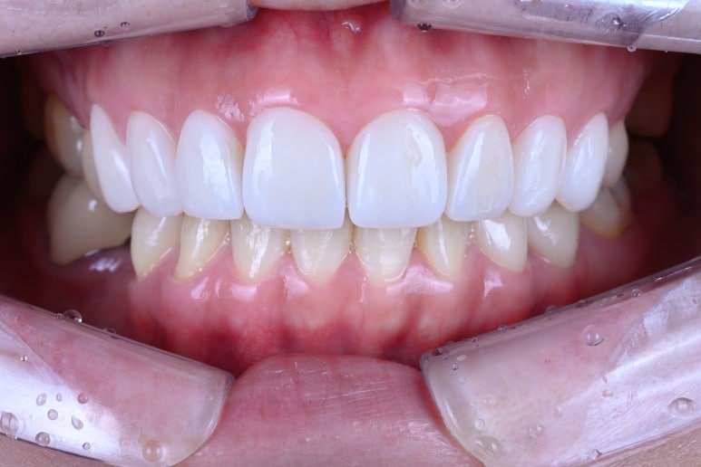 신사역 라미네이트. 결혼식 전 앞니 고민, 얇은 세라믹 레브네이트로 해결! 관련 이미지 15