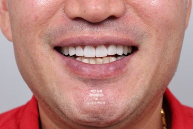 신사역 무삭제 라미네이트 : 레브네이트 내츄럴 최소삭제 비니어. 50대 앞니 벌어짐 비용/후기/얼굴사진. 관련 이미지 18