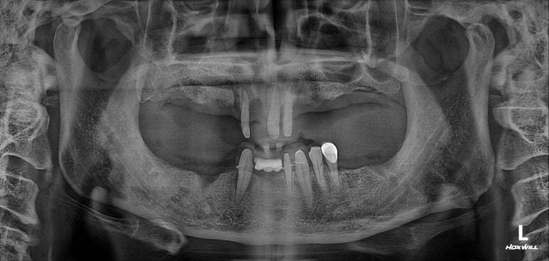 큰 어금니를 잃을 정도의 풍치를 앓으셨다면, 조속한 어금니 임플란트는 필수입니다. 관련 이미지 9
