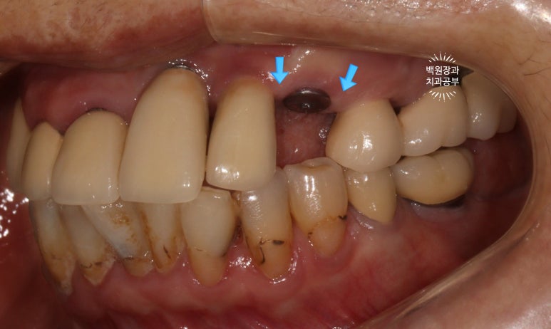 스트라우만 임플란트로 이뽑고 바로심는치과 - 믿고 사용하는 세계 1위 스위스 임플란트 회사. 관련 이미지 15