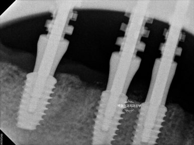 오스템임플란트 네비게이션 전체 임플란트 치료일기. 치료과정/치료기간/비용/솔직후기. 관련 이미지 16