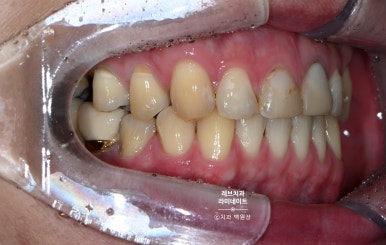 레브네이트 엑스퍼트 ; 유튜버가 선택한 앞니 라미네이트. 앞니 레진 벌어짐을 자연스러우면서 화사하게 바꿔봅시다. 신사역 치과. 치료후기/비용/가격. 관련 이미지 3