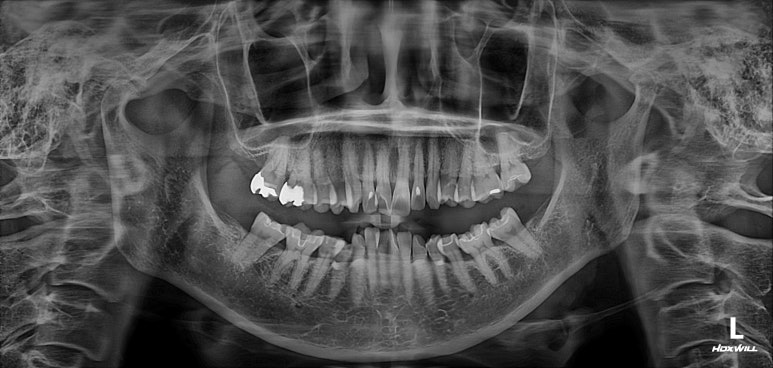 삐뚤어진 앞니를 8개월만에 가지런하게 만드는 50대 성인부분교정. 신사역 교정치과. 치료과정/기간/비용. 관련 이미지 3