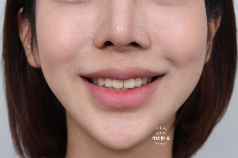 What About Laminates at Sinsa Station? Rev Dental Clinic’s Revnate. image 1