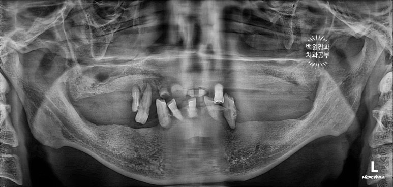 만성치주염으로 인해 아주 좁아진 잇몸뼈에 광범위한 뼈이식 + 전체임플란트. 신사 레브치과. 관련 이미지 3