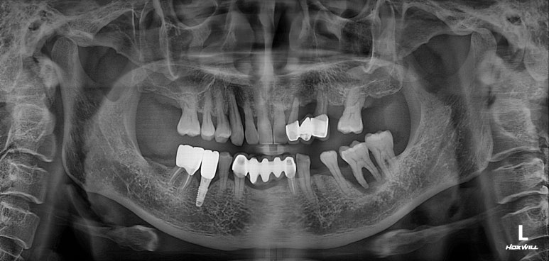 치주염 앞니 잇몸 염증으로 흔들릴 때 - 앞니 브릿지와 임플란트 장단점, 비용. 치료과정과 결과를 눈으로 보여주는 치과. 관련 이미지 3