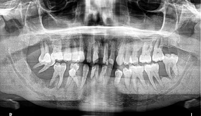 잇몸치료에 대한 모든 것. 치주과 전문의가 설명하는 치주염 치료 비용,과정, 통증, 방법 그리고 치과 실비보험. 관련 이미지 5