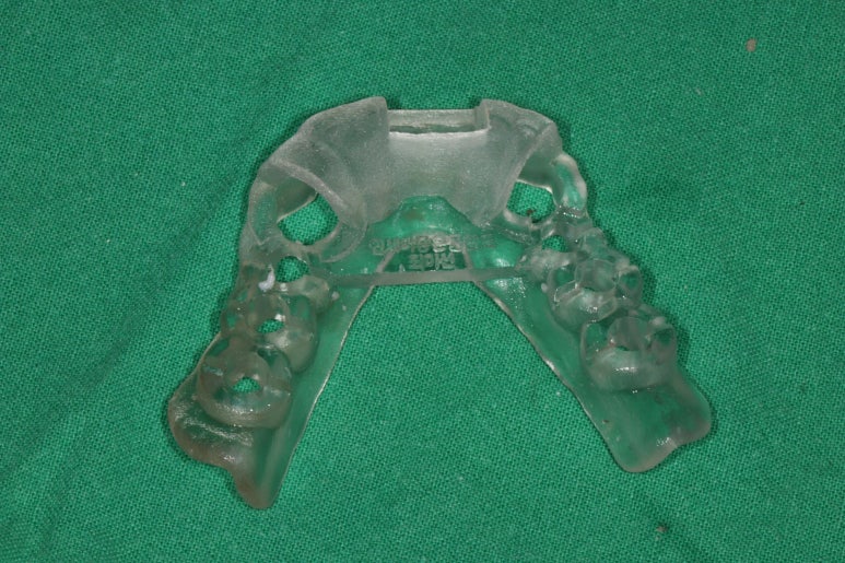 부분틀니를 오래써서 어금니가 아플 때, 아래턱 양쪽 어금니 임플란트 잘하는 강남임플란트치과 관련 이미지 9