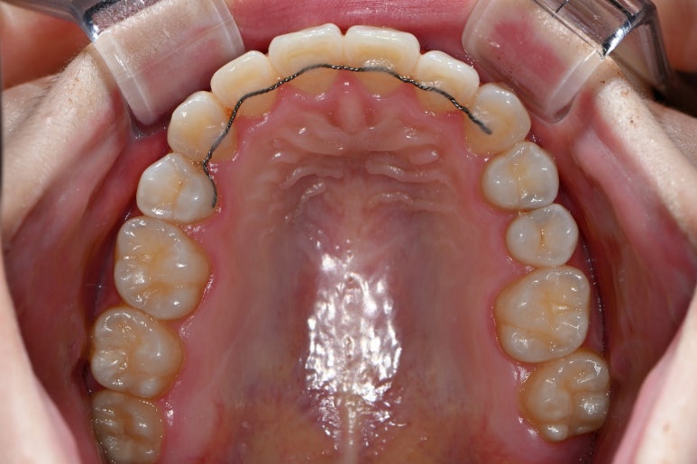 옆면 어금니 충치 하루만에 가능한 논현동 치과. 치아미백 가격 후기. 관련 이미지 6