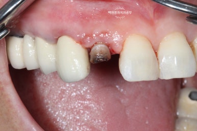 외과적 정출술 (surgical extrusion) - 치아를 살리는 마지막 방법. 치료과정/치료기간/비용/사진. 관련 이미지 8