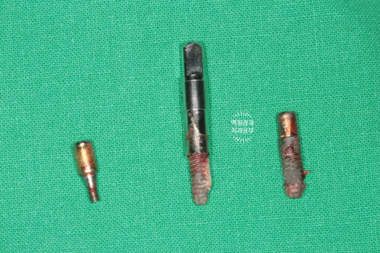 임플란트틀니 - 오버덴쳐. 오스템BA임플란트 이용한 최고의 가성비 치료. 치료과정/치료기간/비용/후기. 관련 이미지 11