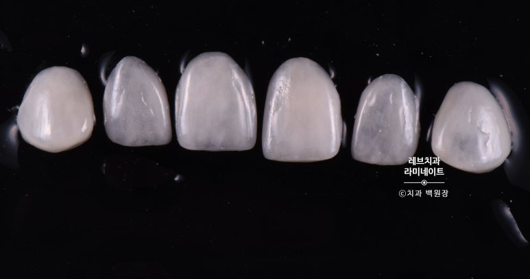 레브네이트 마스터 ; 예비신랑 앞니 무삭제라미네이트. 신사역 치과. 치료후기/비용/가격. 관련 이미지 3
