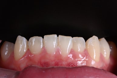 신사역 치과. 아나운서 면접 전 앞니 벌어진 공간을 라미네이트로만 해결할 수 있었던 사연.. 관련 이미지 9