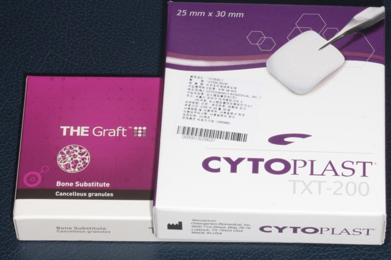 앞니가 풍치로 흔들거려요. 심한 치주염인데 임플란트 가능할까요? 치료과정/치료기간/비용/성공후기. 신금호역 치과 추천. 관련 이미지 20