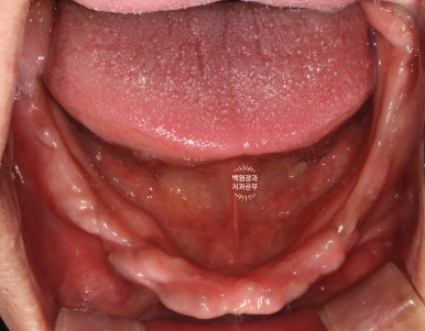 만성치주염으로 인해 아주 좁아진 잇몸뼈에 광범위한 뼈이식 + 전체임플란트. 신사 레브치과. 관련 이미지 11
