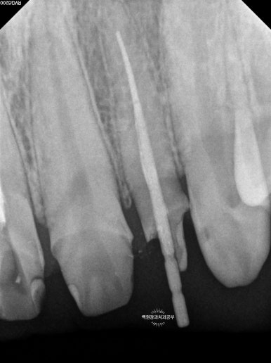 앞니에 잇몸염증과 충치가 심해요. 앞니 지르코니아 크라운 성공 후기. 치료과정/치료기간/비용/전후비교. 관련 이미지 13