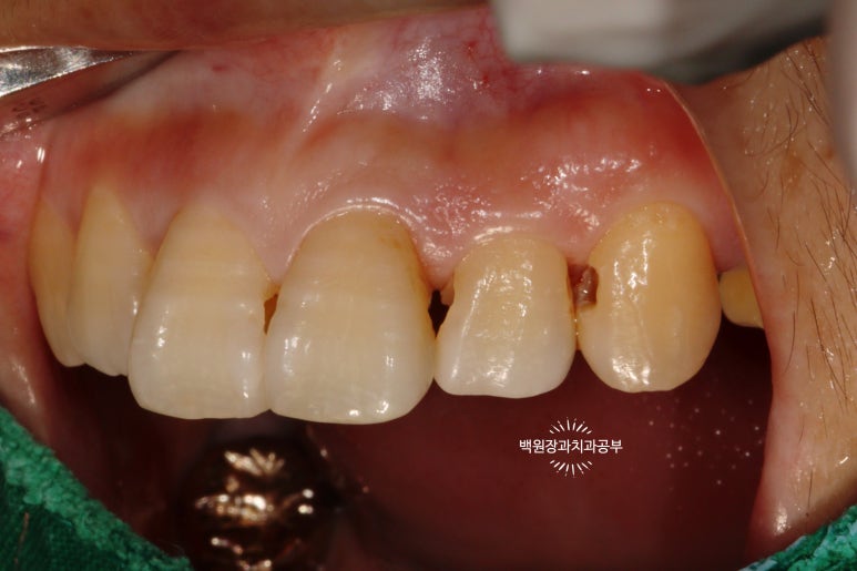 앞니레진치료 할 줄 모르는 치과의사는 없지만, 좋은 레진으로 치료하는 치과의사는 잘 없습니다. 관련 이미지 22