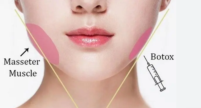 신사역 치과 - 이갈이와 이악물기의 치료. 좋은 보톡스와 이갈이 스플린트. 코어톡스 가격/주기/효과. 관련 이미지 7