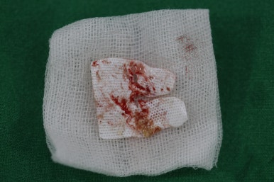 앞니가 풍치로 흔들거려요. 심한 치주염인데 임플란트 가능할까요? 치료과정/치료기간/비용/성공후기. 신금호역 치과 추천. 관련 이미지 26