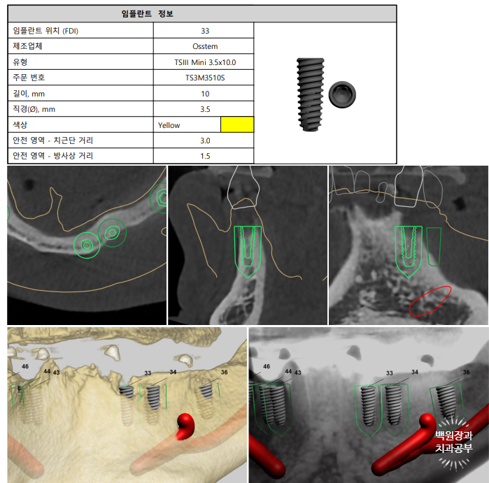 만성치주염으로 인해 아주 좁아진 잇몸뼈에 광범위한 뼈이식 + 전체임플란트. 신사 레브치과. 관련 이미지 18
