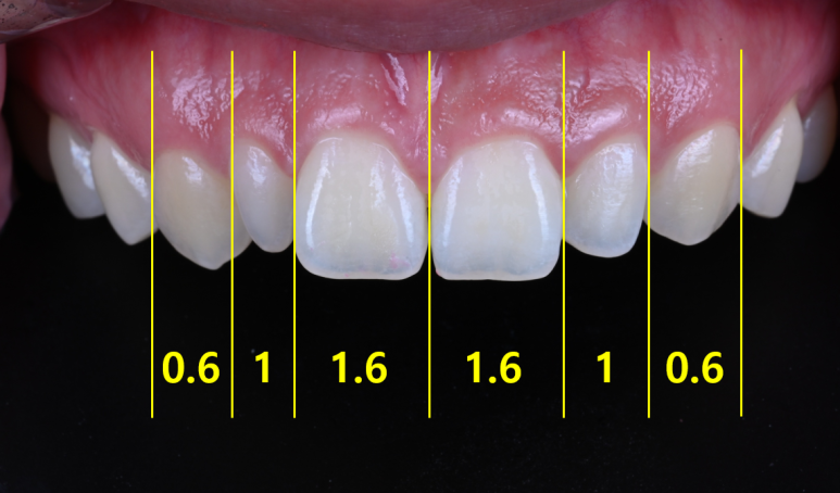 왜소치 라미네이트. 열심히 교정치료 받은 나를 위한 선물. 비용/과정/후기. 관련 이미지 7